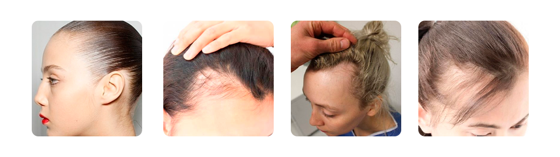 Cabeza con alopecia por tracción